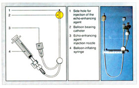 Hysterosalpingo Contrast Sonography