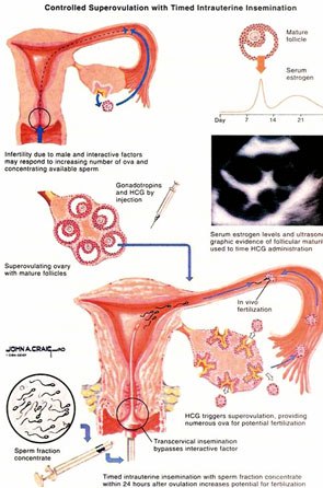 Intra Uterine Insemination