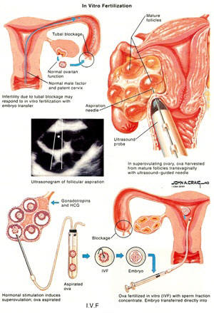 I.V.F procedure