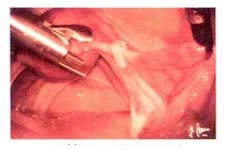 laparoscopie-sterilisation