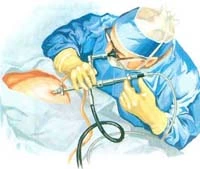 laparoscopy