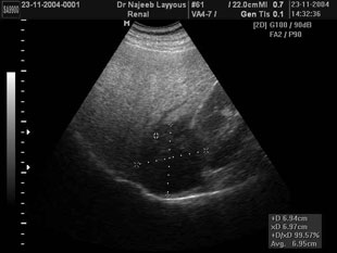 Liver Metastasis