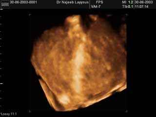 Normal Thyroid