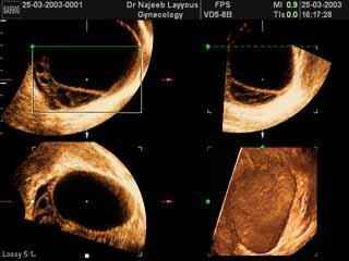 Ovarian Cyst