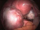 ovarian-cyst