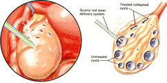 Ovarian Drilling