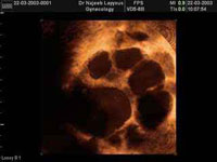 Ovarian Follicles as seen by Trans-vaginal ultrasound