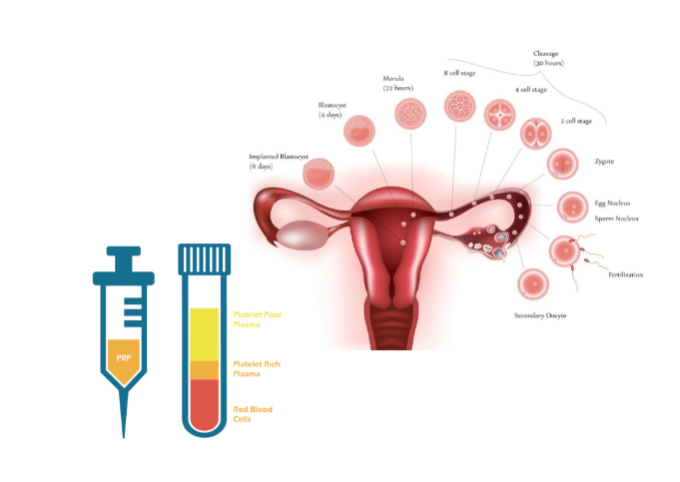 ovary-plasma-injection