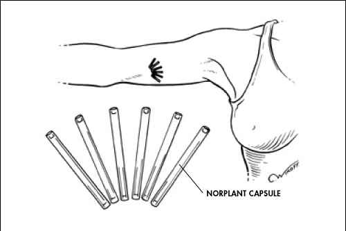 Progestrogen only implants