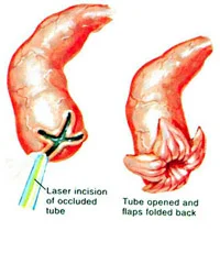 salpingostomy