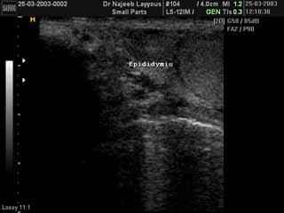 Epididymis