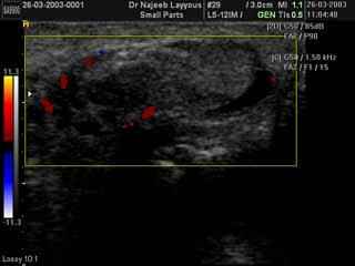 Epididymis Doppler