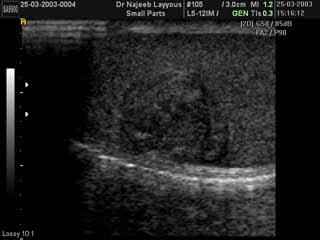 Sertoli cell tumour of the testis 