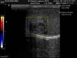 Sertoli cell tumour of the testis Doppler