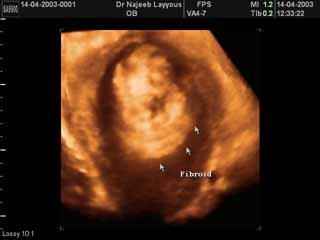 Submucous Fibroid