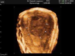 Submucous Fibroid