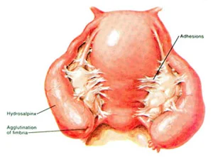 Blocked Tubes and Adhesions