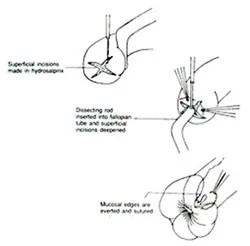 Surgical treatment for female infertility