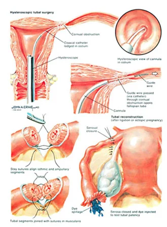 Surgical treatment for female infertility