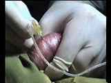 Testicular Sperm Aspiration (TESA)