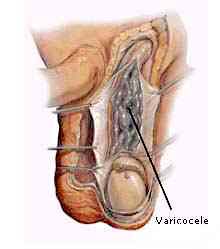 varicocele