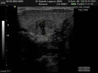 Thyroid Adenoma