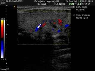 Thyroid Adenoma With Doppler