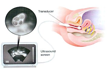 Trans-vaginal ultrasound