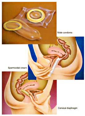 Types of contraception