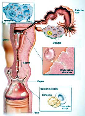 Types of contraception