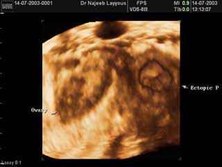 Intact tubal pregnancy