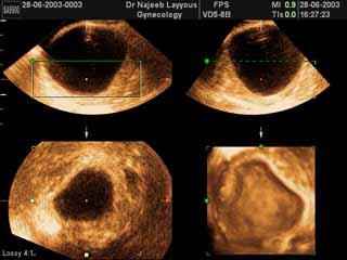 Ovarian Cyst