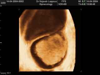 Ovarian Dermoid
