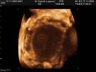 Ovarian Endometrioma