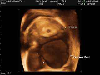 Early Pregnancy with Ovarian Cyst