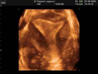 Transrectal Ultrsound showing normal uterus