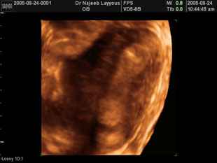 Uni-Cornuate uterus