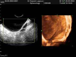 Urinary Bladder 3D