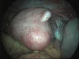 uterine-fibroids