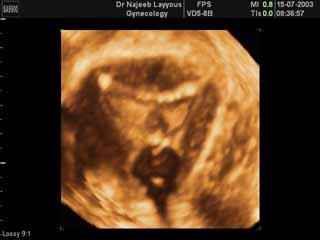 Uterus as seen in performing HY-CO-SY