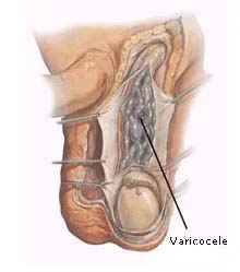 Varicocele