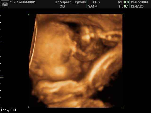 Fœtus de 25 Semaines