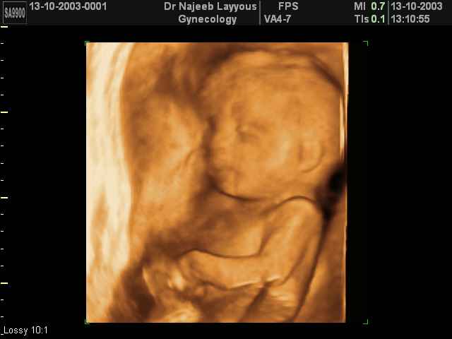 Fœtus de 22 Semaines