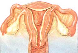 Polype Endométrial