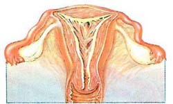 Intrauterine Adhérences