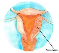 Adenomyosis