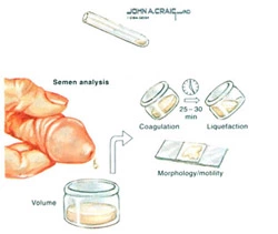 Analyse liquide séminale