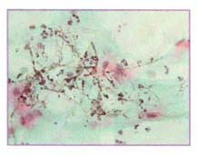 Candidiasis dans un frottis cervical