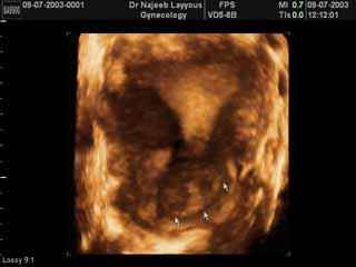 col de l'utérus fibromes