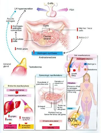 Clinical presentation of Polycystic ovaries